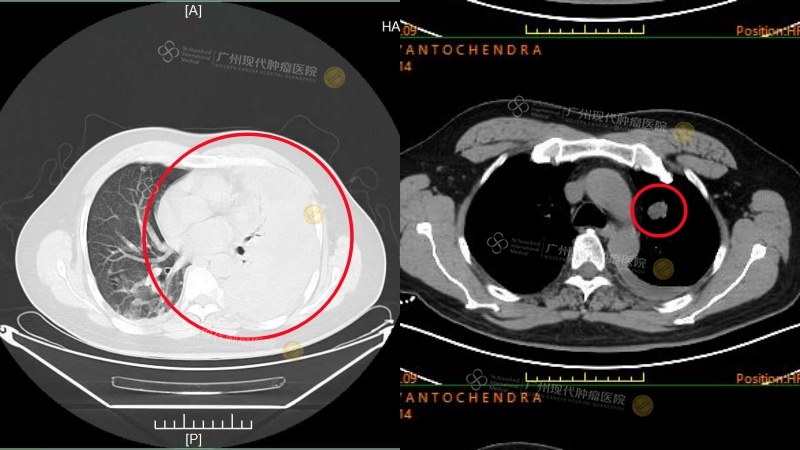 1-075133637.jpg 哈-肺部治疗前肺部胸腔积液VS治疗后.jpg