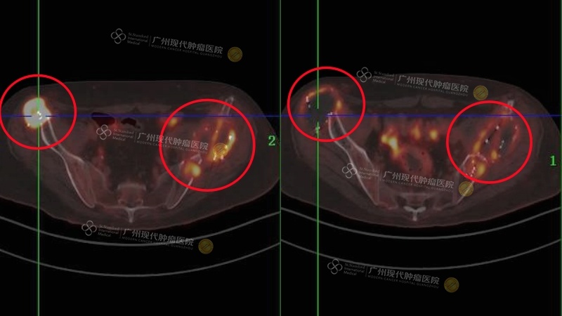 1-075142600.jpg 哈-双侧髂骨:第二次入院时VS治疗后.jpg